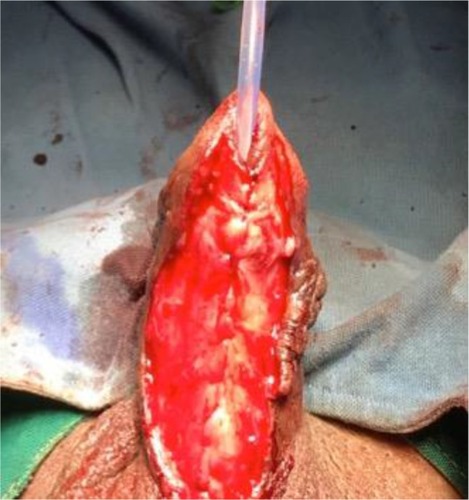 Figure 15 Urethral tubularization.