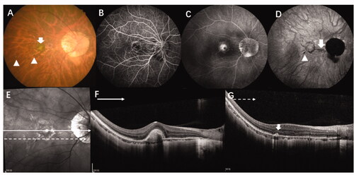 Figure 4. Multimodal images of a 36-year-old woman with high myopia (-9D in both eyes) where it was difficult to determine the aetiology of CNV. (A) A colour fundus photograph of the right eye shows typical high myopia changes including peripapillary atrophy, leopard fundus, and posterior staphyloma. In addition, there is a yellowish lesion in the macular region (green arrow) corresponding to CNV as well as two very small lesions (yellow arrow) in the infer-temporal retina. (B, C) FFA showing early hyperfluorescence and late leakage. (D) Late phase of ICGA showing a lacquer crack underneath the CNV lesion (red arrow) and a hyporeflective spot which corresponds to a very small lesion which can be seen in the fundus photograph (yellow arrow). (E, F) OCT scan of the CNV lesions (green line) shows high reflectance on the RPE and rupture of the ellipsoid zone. (G) OCT scan of the lesion seen in the fundus photograph and ICGA (yellow arrow) shows sub-RPE hyperreflexia with choroidal hyper-transmission and adjacent ellipsoid zone disruption which is similar to OCT findings of an inflammation lesion caused by MFC/PIC. CNV: choroidal neovascularization; MFC; multifocal choroiditis; OCT: optical coherence tomography; FFA: fundus fluorescein angiography; RPE: retinal pigment epithelium.