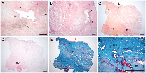 Figure 3. (A–C) Urethral sections with fibrosis and sclerosis classified as grades I–III: (A) grade I; (B) grade II; (C) grade III. L, lumen. F, fibrosis. Sc, Sclerosis. Arrowheads, inflammation; arrow; germinal centre formation. (Van Gieson stain.) (D–F) Urethral tissue sections of grade III with sclerosis in (D) H&E and (E) Masson’s trichrome; (F) higher magnification of (E). Scale bars = 500 μm.