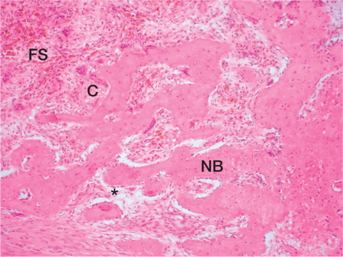 Figure 3. Typical histological section from a sample of a graft from a goat that received meloxicam (hematoxylin and eosin). New woven bone (NB) in a fibrovascular stroma (FS), with osteoblasts (*) and osteoclasts (C) comparable to the bone formation in goats that received ketoprofen. Magnification 50x.