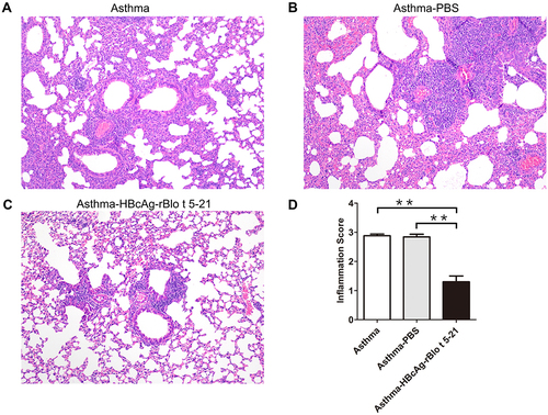 Figure 5 Mouse lung sections stained with hematoxylin and eosin. (A). Untreated model mice (asthma model). (B). PBS-treated model mice (asthma-PBS). (C). Model mice treated with HBcAg–rBlo t 5–21 (asthma–HBcAg-rBlo t 5–21). (D). Lung inflammation was defined as the peribronchial inflammation score (n = 5). Values are expressed as mean ± SEM, ** p < 0.01.
