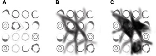 Figure 3 Schiffner progression model fo LM/LMM. Initially asymmetric pigmentation and dots around the follicle are seen (A), which later evolve to rhomboidal structures (B) and finally form homogeneous pigmented areas and cause obliteration of the follicular openings (C). Adapted with permission from Dermoscopedia (https://creativecommons.org/licenses/by-nc-sa/4.0/).Citation158