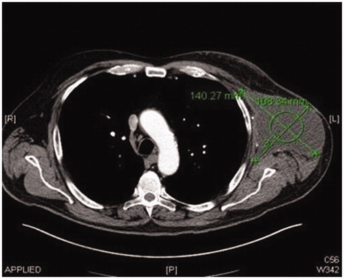 Figure 1. Preoperative CT scan image showing left axillary chronic seroma.