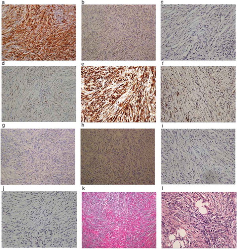 Figure 3. Histopathological and immunohistochemical appearance. (a) Positive immunostaining with monoclonal rabbit anti-human CDK4 (EP189, Zhongshan). (b) Positive immunostaining with monoclonal mouse anti-human MDM2 (SMP14, Thermo Fisher). (c) Negative immunostaining with monoclonal rabbit anti-human CDK2 (E304, Abcam). (d) Sporadically positive immunostaining with monoclonal cyclin D1 (EP12, Roche). (e) Diffusely positive immunostaining with p16ink4a (E6H4, Roche). (f) Sporadically positive immunostaining with polyclonal rabbit anti-human p19ink4d (Abcam). (g) Negative immunostaining with monoclonal mouse anti-human ALK (OTI1A4, Zhongshan). (h) Negative immunostaining with monoclonal mouse anti-human p53 (D0-7, Leica). (i) Negative immunostaining with monoclonal rabbit anti-human cyclin E1 (SP146, Abcam). (j) p21 WAF1 (DCS-60.2, Zhongshan Golden Bridge). (k) Low-power view showing the tumor to be mainly composed of spindle cells, collagen fibers, and inflammatory infiltration consisting of an increasing number of plasma cells and lymphocytes (H&E staining, × 10). (l) High-power view shows very little atypia and low-level mitosis (H&E staining, × 400).