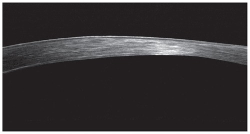 Figure 3 Picture showing the same portion of cornea as in Figure 2, in a cornea OCT 12 months following the treatment. The scar has been significantly reduced, the stromal surface smoothed, the epithelium has become more uniform in thickness, and the overall cornea thickness has been reduced.