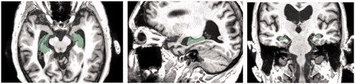 Figure 9. Data process: using Segment Editor The hippocampus is highlighted in green.