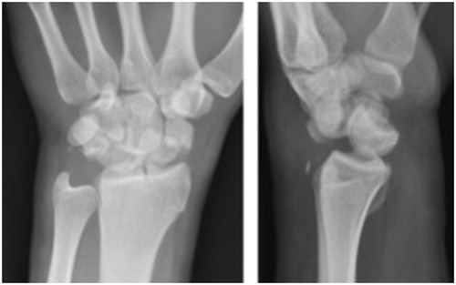 Figure 1. Injury PA and lateral of the left wrist. Fractures of the distal radius, scaphoid, triguetrum, and ulnar styloid. Note the dorsal dislocation of the capitate and the volar rotation of the lunate on the lateral radiograph. Note the absence of joint space around the lunate as well as superimposition of the capitate on the PA radiograph.