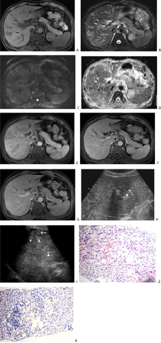 Figure 1 A 46-year-old man with AIDS-related hepatic Kaposi’s sarcoma. Plain scan MRI shows multiple nodular lesions in the liver, with low signal on T1 weighted imaging (1A), high signal on T2 weighted imaging (B), slightly high signal on diffusion weighted imaging (C), and high signal on apparent diffusion coefficient imaging (D). Enhanced scanning of the arterial phase (E) showed circular enhancement, located adjacent to the portal vein and under the hepatic capsule. The portal vein phase (F) shows gradual enhancement of nodules, showing equal to slightly lower enhancement, and dilation of intrahepatic bile ducts. The delayed phase (G) shows high and equal enhancement of the nodules, with intrahepatic bile duct dilation observed. Ultrasound (H) showed multiple hypoechogenicity (arrow) in the liver, as well as thickening and enhancement of the Glisson sheath (arrowhead). After 40 days, ultrasound (I) revealed multiple hyperechoic nodules in the liver (arrows), as well as thickening and enhancement of the Glisson sheath (arrowhead). The pathological HE staining (J) of the puncture biopsy showed residual liver tissue on the left side and a tumor area on the right. The spindle shaped tumor cells were arranged in a striped pattern, with some appearing as fissures. The nucleus was ovoid, and the cells were mildly atypical. No clear mitotic image was observed (HE X200). Human herpesvirus 8 immunohistochemistry staining (K) showed partial spindle cell nucleus positivity (EnVision X200).