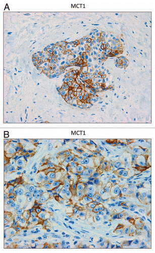 Figure 6 MCT1 is expressed in the epithelial compartment of human breast cancers. Note that only epithelial cancer cells express MCT1 in human breast tumor samples. Two representative images are shown. Both clearly show that MCT1 staining is present in the tumor epithelial cells, but is absent in the surrounding stroma. Panel (A) shows DCIS-like lesions and the surrounding MCT1(+) epithelial cancer cells. Panel (B) shows that MCT1 staining identifies the epithelial cancer cells within the “cancer cell nests.” The original magnifications for (A and B) are 40× and 60×, respectively.