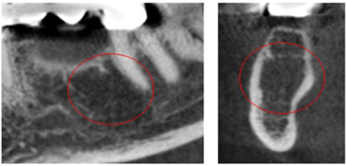 Figure 1 BMDJ barely detected on X-Ray (left, area in the red circle), confirmed by CT-scan (right, area in the red circle).