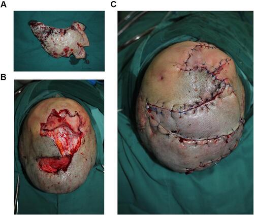 Figure 4 Surgical removal of large skin lesions (A), surgical incisions (B), postoperative sutures (C).