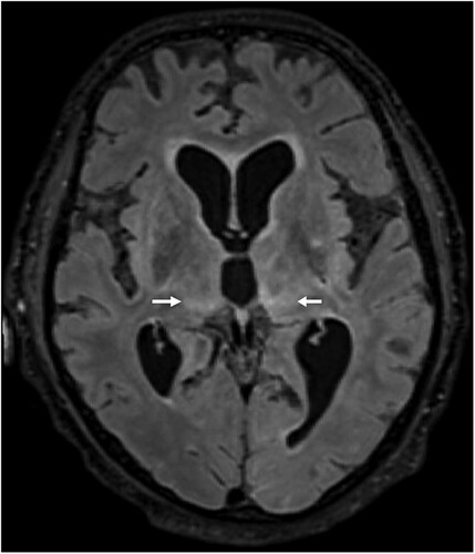 Figure 3. Cranial magnetic resonance imaging of case 2. In this case of a confirmed BoDV-1 encephalitis, widespread increase of signal intensity, especially of the thalami (arrows) is detected. Transversal T2-weighted fluid attenuated image (FLAIR).