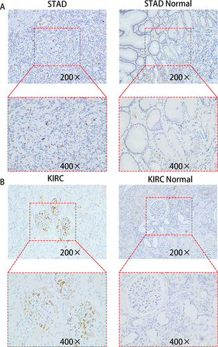 Figure 12 Immunohistochemistry of CD19 in STAD, KIRC, and normal tissues. (A) CD19 expression was higher in STAD than that in normal gastric tissues. (B) CD19 expression in KIRC was higher than that in normal renal tissue.