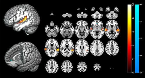 Figure 2 Brain areas showing different activation between sleep-related sound and neutral sound. There was significant greater activation in bilateral temporal regions (red and yellow color) and deactivation in pregenual anterior cingulate cortex (blue color) in response to SS compared to NS. The statistical threshold was cluster-wise corrected p < 0.05 (97 voxels). Cluster size was calculated by 3dClusSim.