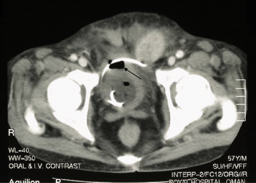 Figure 3. CT scan showing the presence of gas in the urinary bladder.