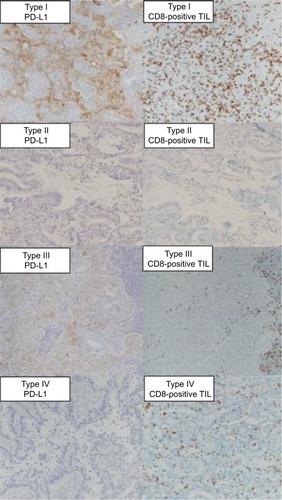 Figure 2 Representative sections of lung adenocarcinoma tissues with CD8-positive TILs and cell membrane staining for PD-L1 according to tumor immune microenvironment classification.