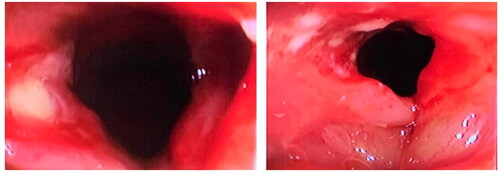 Figure 3. Images obtained from bronchoscopy represent the vocal cords, showing the left vocal cord without anatomical compromise and the right vocal cord with the presence of electrical burn lesions.