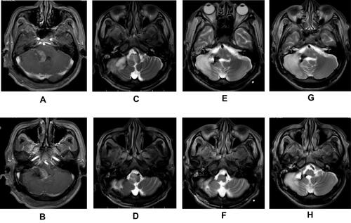 Figure 3 Cranial MRI images. (A and B) Cranial MRI imaging on admission to the department of hematology. (C and D) Cranial contrast-enhanced MRI imaging on the day before the third course showed that the mass in the cerebellopontine angle area had clearly enlarged. (E and F) Cranial contrast-enhanced MRI imaging on the day before the fourth course showed that the mass was reduced significantly. (G and H) Cranial contrast-enhanced MRI imaging on the day before the fifth course showed that the mass disappeared with cicatricial changes.