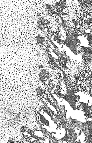 Figure 3 Мicrophotograph. Spongy tissue of periosteal regenerate bordered by hyaline cartilage. Haematoxylin and eosin staining. x90.