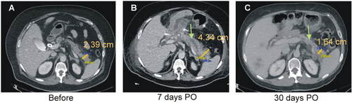 Figure 4. Clinical results. Typical CT images before (A), 7 days (B) and 30 days after TAMPD (C). Both the transverse diameter of the remaining pancreas (clear bar) and maximum diameter of the MPD (green arrow) increased at 7-day PO and then reduced at 30-day PO.