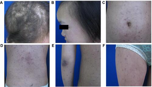 Figure 3 Clinical manifestations after neurosyphilis therapy. Erythema and papules on the scalp (A), face (B), trunk (C and D) and extremities (E and F) were significantly improved after neurosyphilis therapy treatment.