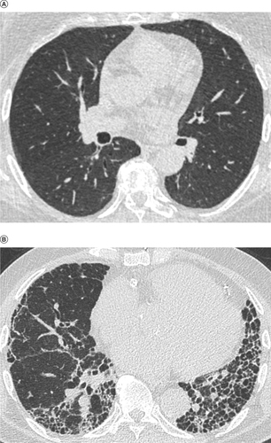 Figure 2. Scans of healthy lungs and lungs affected by fibrosis.(A) Healthy lungs. (B) Lungs affected by fibrosis.Provided by and reproduced with permission from Professor Simon LF Walsh, National Heart and Lung Institute, Imperial College London, UK.