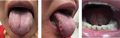 Figure 1. Tongue presentation during initial patient exam.