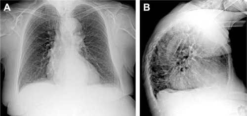 Figure 2 Chest X-ray in PA (A) and LL (B) projections. Chest X-ray has poor sensitivity to detect COPD; possible findings include prominence of the hilar vessels and decreased peripheral bronchovascular markings, flattened diaphragm due to hyperexpansion and hyperkyphosis and increased lung lucency (especially seen in the retrosternal region in LL projection) and bullae (round focal lucency over 1 cm).