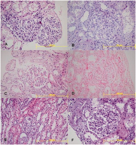 Figure 1. (A) Mild; (B) severe mesangial hypercellularity in IgA nephropathy; (C) mild; (D) severe mesangial hypercellularity in IgM nephropathy; (E) mild; (F) severe mesangial hypercellularity in isolated MsPGN.