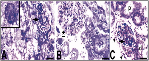 Figure 4. Light microscopy of renal tissue samples which are obtained from the Hg group. Arrow (A), glomerular sclerosis; *Bowman’ s space which enlarged according to the control group (B); arrow and arrow head (C), glomerular degeneration and degenerated podocyte, respectively; p, proximal tubule; d, distal tubule (C). Bars show 50 μm. Inset shows necrotic tubule.