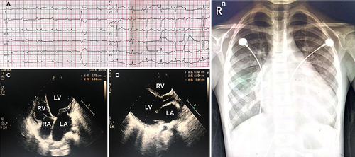 Figure 2 Electrocardiogram (ECG), Chest x-ray, and Echocardiography of our Carvajal syndrome patient with novel variants in the desmoplakin gene. (A) Echocardiography showing ventricular premature beats; (B) Chest x-ray showing dilated heart and increased cardiothoracic ratio; (C and D) Echocardiography showing dilated left and right ventricles.