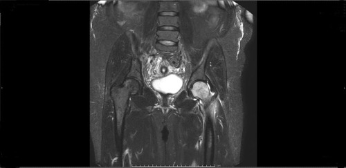 Figure 1 T2-weighted MRI: Coronal view indicating diffuse bone marrow edema of the left hip.