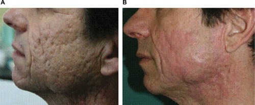Figure 4 Patient treated with the double anterior chemabrasion technique.