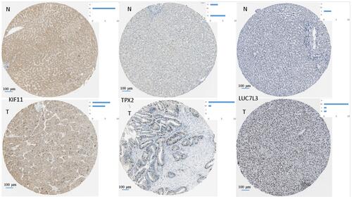 Figure 8 Representative images for immunohistochemical staining of the hub genes TPX2 (M5), LUC7L3 (M1), and KIF11 (M7), which were all up-regulated in liver cancer according to the Human Protein Atlas. The blue bar in the upper right denotes the cases with high, moderate, low, and not detected signals.