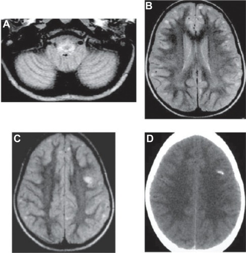 Figure 3 MRI FLAIR.