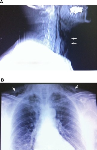 Figure 1 (A) X-ray of neck lateral incidence. (B) X-ray AP incidence.