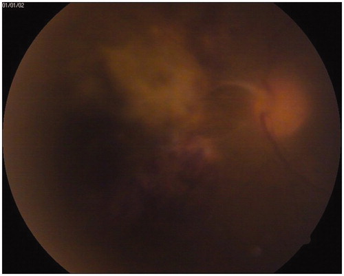 FIGURE 1.  CMV retinitis involving the nasal retina.