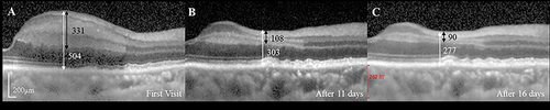 Figure 4 A female ages 65–75 years old with hypertension presented with acute vision loss and periocular pain in the right eye. Visual acuity was no light perception (logMAR equivalent, 3.0) at presentation, and the IOP was 63 mmHg; SD-OCT displayed the development of PAMM lesions in an APACG patient. (A) Distinct hyper-reflective lesions at INL extended into IPL and OPL (stage I, edema); (B) Distinct attenuating OPL thickness (stage II, edema resolution); (C) Severe INL thinning (stage III, atrophy). The white / black arrow represents the full / inner retinal thickness (µm) at the thickest part of stage I lesion and the thinnest part of stage II or III lesions.