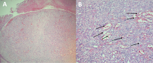 Figure 2 (A) Tumor masses growing inward and outward were seen in the mid dermis of the section; the epidermis above was missing and covered with pus and blood crust, and the epidermis on both sides was extended in a collar shape (HE, 40×). (B) A dense, narrow mature vascular lumen formation was seen in the dermis, containing erythrocytes, spaced with loose collagen tissue, plexiform vascular endothelial cell growth was seen, and formed lumen, no cellular anisotropy, and erythrocyte spillage (black arrows) was seen (HE, 200×).
