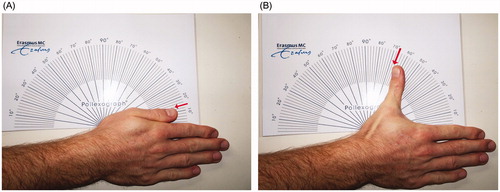 Figure 1. Position of the hand during Pollexograph-thumb angle measurement. Radial adduction (A) and radial abduction (B) are assessed at the radial edge of the thumb, indicated by the red arrow.