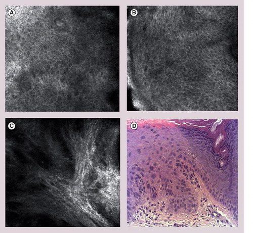 Figure 4. Reflectance confocal microscopy images of actinic keratosis.(A & B) Loss of normal epidermal honeycomb pattern, architectural diarray, cellular atypia and pleomorphism. (C) Marked solar elastosis in the upper dermis. (D) Representative hematoxylin and eosin histology of actinic keratoses with proliferation of atypical keratinocytes (‘crowding’).
