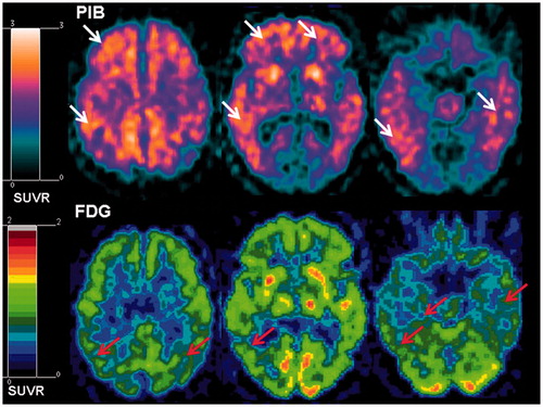 Figure 5. Amyloid deposition (upper panel, white arrows) and glucose hypometabolism (lower panel, red arrows) in an AD patient. Images from [11C]PIB-PET and [18F]FDG-PET, respectively. SUVR, standardised uptake value ratio, presented as ratios to cerebellum).
