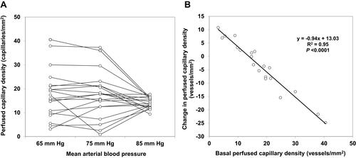 Figure 5 (A) Sublingual perfused capillary density at 65, 75, and 85 mm Hg of mean arterial blood pressure. (B) Correlation between basal sublingual perfused capillary density (at 65 mm Hg of mean arterial blood pressure) and the change in sublingual perfused capillary density at increasing values of mean arterial blood pressure. Reprinted with permission from Dubin A, Pozo MO, Casabella CA, et al. Increasing arterial blood pressure with norepinephrine does not improve microcirculatory blood flow: a prospective study. Crit Care. 2009;13(3):R92. Copyright © 2009 Dubin et al.Citation34 