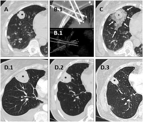 Figure 3. Cryoablation of a posterior right basal lung metastasis with four needles. A. Lung metastasis before treatment (black asterisk). B. Final positioning of the four needles (arrowheads) in the lung lesion (asterisk) in MIP (B(0).1) and VR (B(0).2) reconstructions. C. Lung lesion at the end of the treatment (asterisk) with minimal peripheral intra alveolar hemorrhage (white arrows). D. Control of cryoablation scares (asterisks) at 1 month (D(0).1), 3 months (D(0).2) and 6 months (D(0).3).