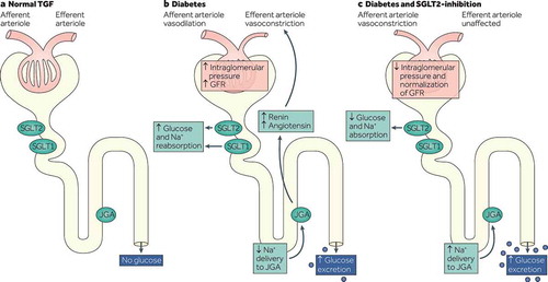 Figure 1. Effect of T2D and SGLT-2is on afferent and efferent arteriolar modulation, GFR, and sodium excretion in the renal tubule. (A) In individuals without diabetes, all of the filtered glucose is reabsorbed (along with Na+) by SGLT-2 and SGLT-1, and TGF is maintained; (B) in patients with T2D, glucose reabsorption is increased by SGLT-2 and SGLT-1; and (C) in patients with T2D receiving SGLT-2is, reabsorption of glucose and Na+ is increased and glucose is excreted in the urine. Reproduced with permission from DeFronzo et al. Nat Rev Nephrol. 2017;13:11–26 [Citation29]. GFR, glomerular filtration rate; JGA, juxtaglomerular apparatus; Na+, sodium; SGLT, sodium–glucose cotransporter; SGLT-2is, SGLT-2 inhibitors; T2D, type 2 diabetes; TGF, tubuloglomerular feedback.