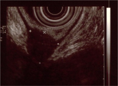 Figure 1 This is an endorectal ultrasound revealing a deep endometriosis nodule involving the muscular layer of the rectum.