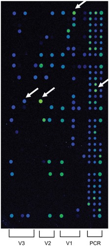 Figure 2 Results of the hybridization assay for polymerase chain reaction (PCR) amplifications from vitreous sample of case 1. PCR products are spotted as a reference on the right side. Green or blue (arrow) circles in V1, V2, and V3 represent strong hybridization. Bacterial identification is determined by the combination of strong hybridization in V1, V2, and V3. This case shows a pattern of Klebsiella pneumonia.