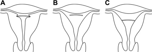 Figure 4 (A–C) Geometric relation of a properly inserted intrauterine device (IUD) to endometrial cavities with various inappropriate fundal transverse dimension. (A) Fundal transverse dimension significantly smaller than the length of the transverse arm of the IUD; (B) fundal transverse dimension significantly greater (initial position of the IUD); (C) fundal transverse dimension significantly greater (possible subsequent position of the IUD).