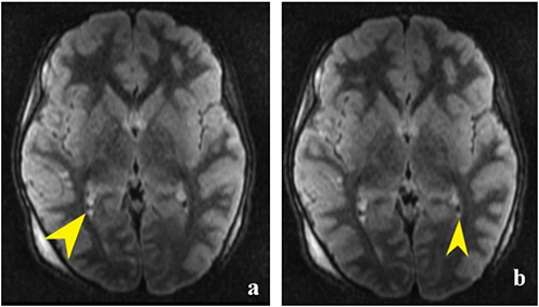 Figure 8 An 8-year-old girl was in a motor vehicle accident. (a and b) Small FLAIR hyperintense signal areas (yellow arrowheads) suggest intraventricular hemorrhage in the occipital horns of the lateral ventricles.