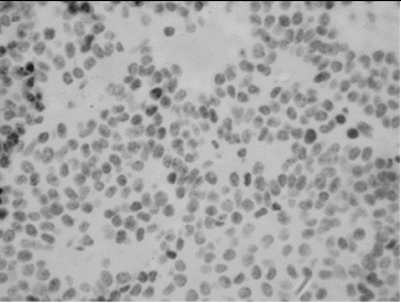 Figure 1. Single MIB-1 positive nuclei in a case with prolactinoma (IHC, x100).